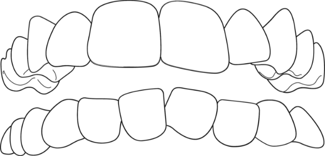 Crowded Teeth